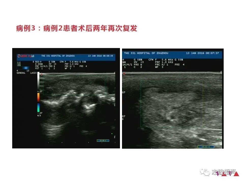 腱鞘鉅細胞瘤_超聲