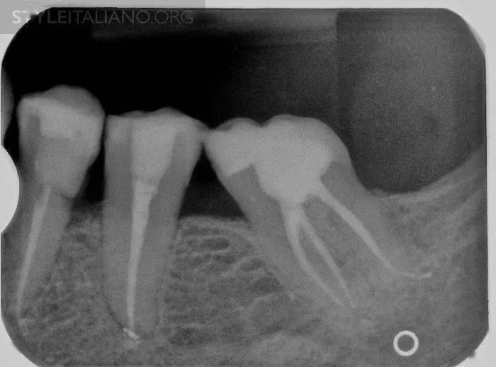 口腔医院专家解读图1中远中根充至根尖2mm以内,属于恰填范围,且根管