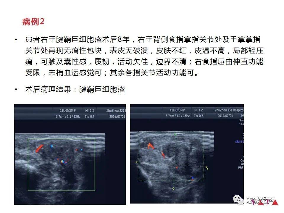 腱鞘鉅細胞瘤_超聲