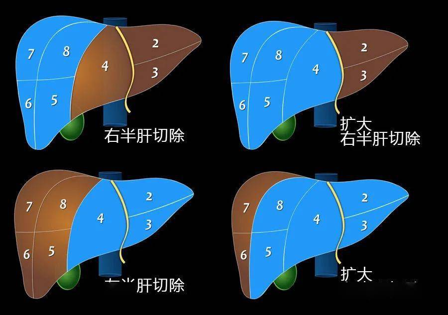 肝脏的五叶八段中文图图片