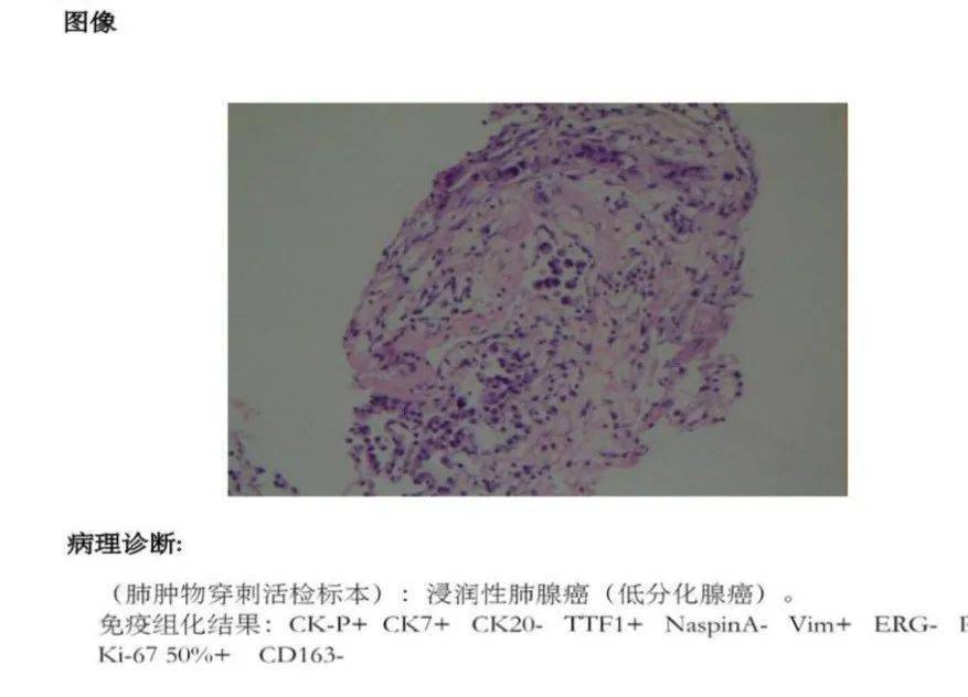 检查|【新闻快递】呼吸重症监护室成功开展两例危重症患者“床旁超声引导下经皮肺穿刺组织活检术”