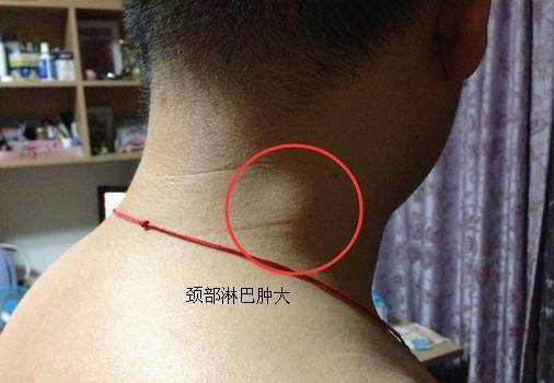 人体三处淋巴决定生死60