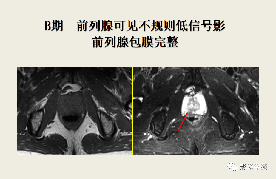 磁共振前列腺图像解析图片