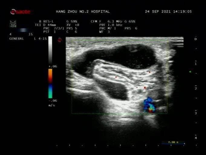 图 18 腘窝囊肿图片来源:作者提供图 19 腘窝囊肿图片来源:作者提供图