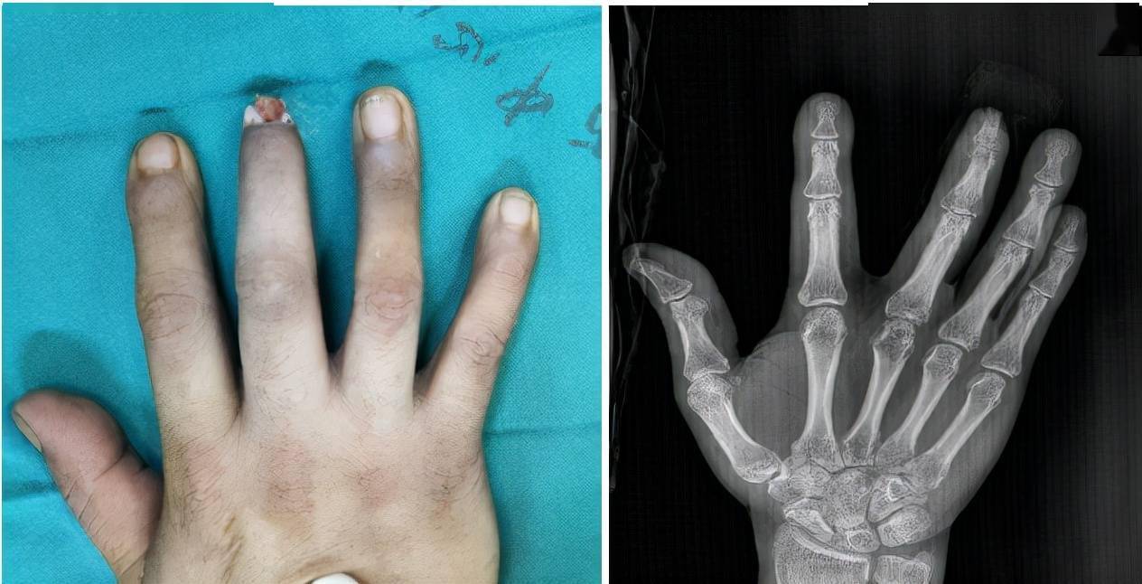 男子施工致手指末节离断 手指再造术助他圆残缺之憾 王江辉