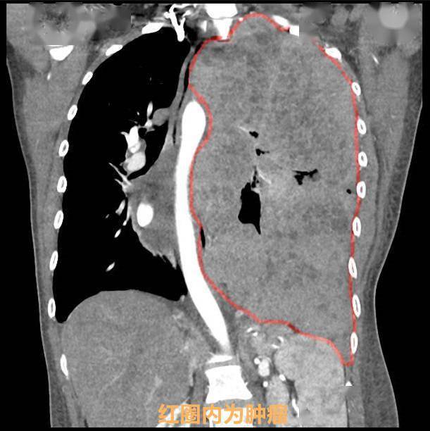 女子|年轻女子胸腔长了个大西瓜般肿瘤，还好巨瘤介于良恶性边缘