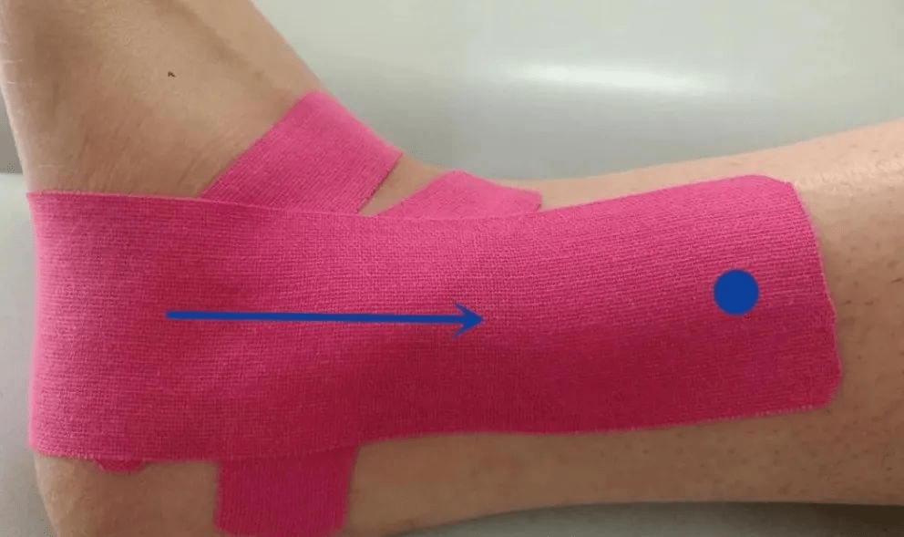 edg夺取2021全球总冠军手上贴的是什么肌内效贴