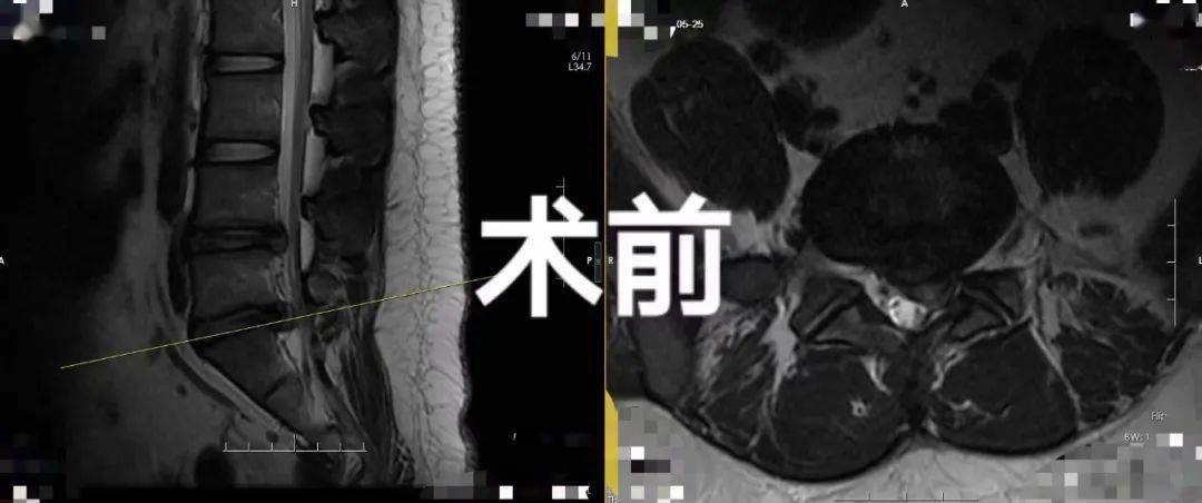 左腿|每天久坐16个小时，21岁小伙腰椎间盘突出