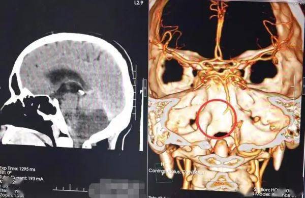 脑血管|男子长期熬夜打麻将，“打爆”脑血管致小脑梗死险丧命
