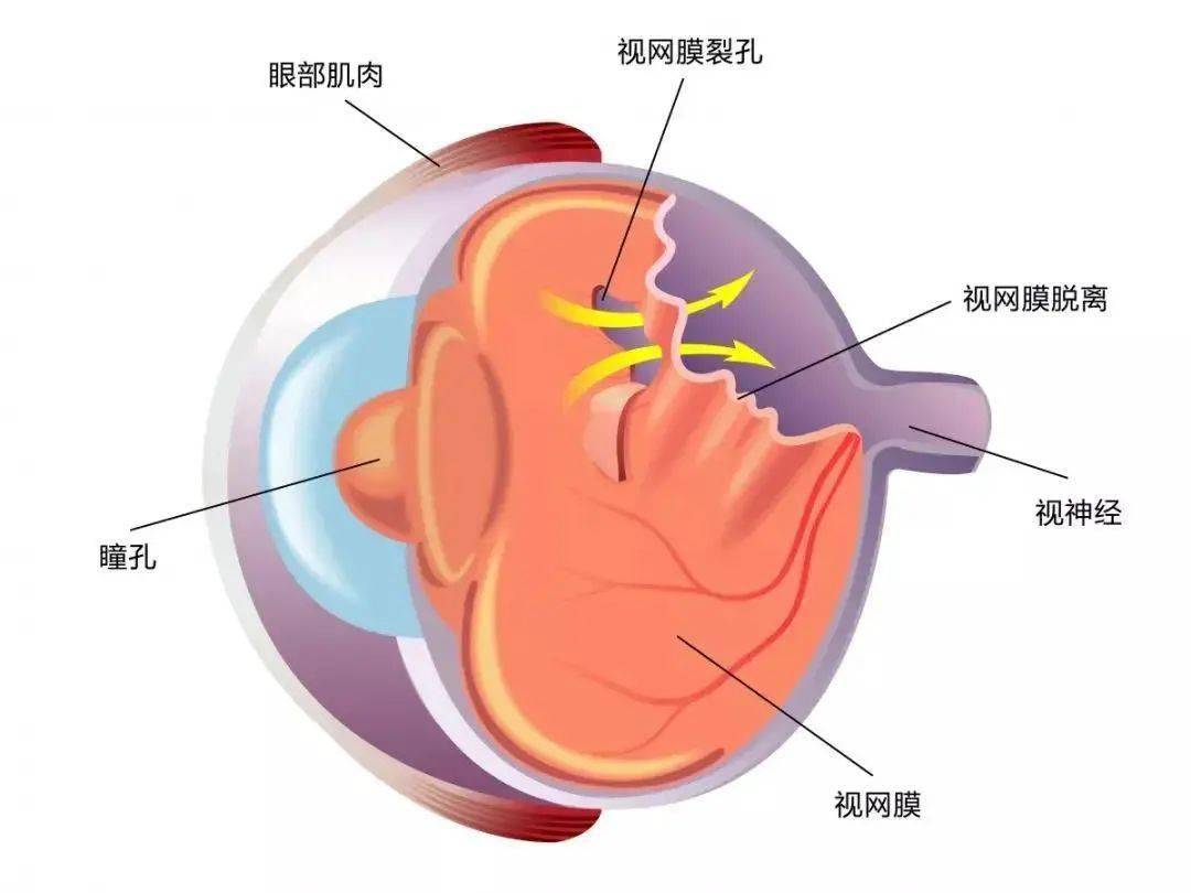 脉络膜裂位置图片