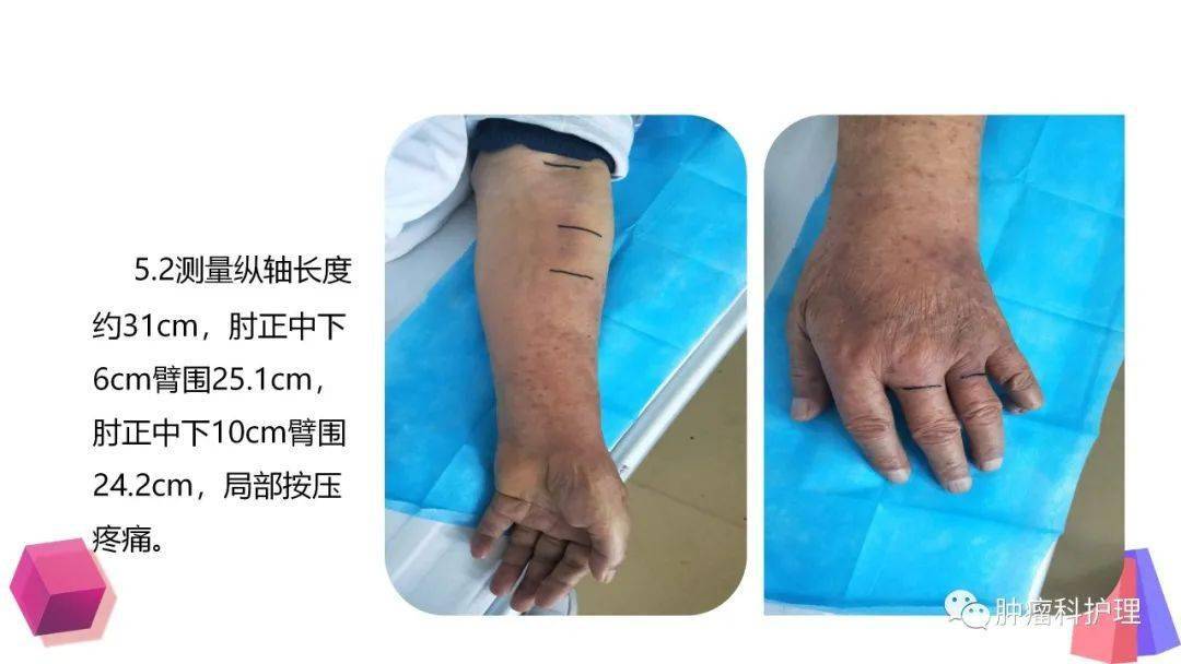 ppt一例脂肪乳外渗案例分析