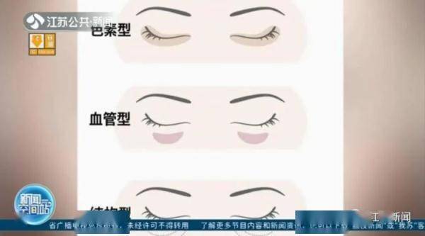 胡亮|南京一医院开设黑眼圈门诊！网友沸腾了：马上去挂号！