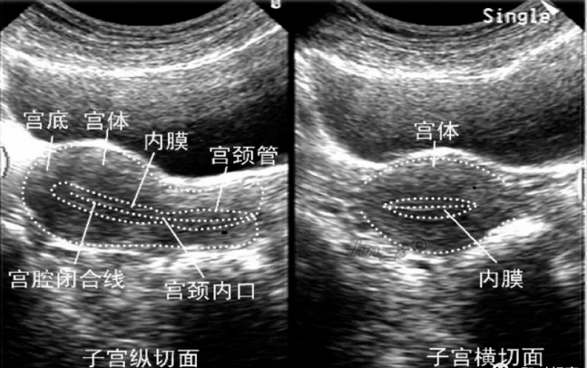 各時期正常女性生殖器官的超聲聲像表現!_子宮