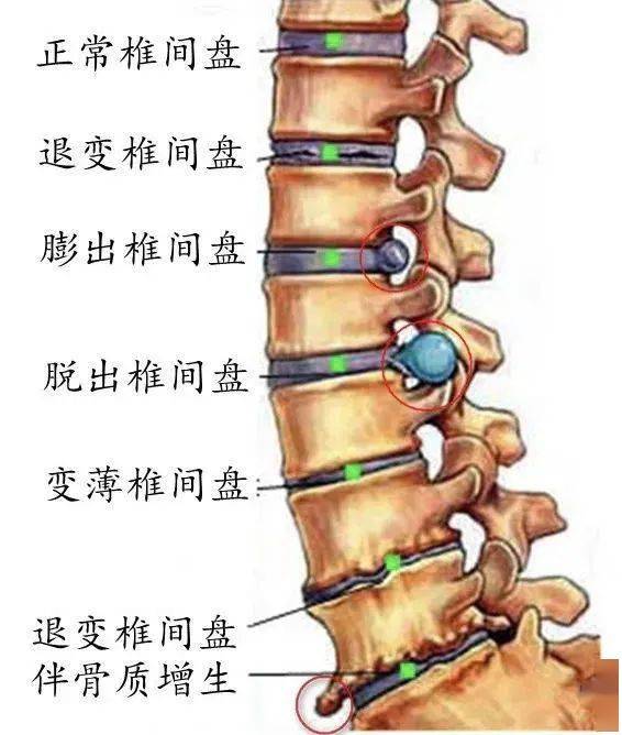 腰椎终板解剖位置图片