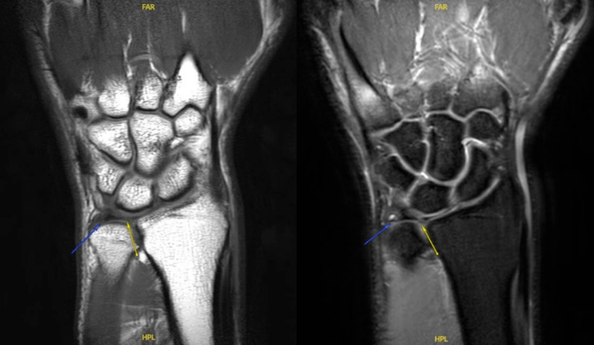 mr检查图中箭头所指为异常信号表现,提示tfcc损伤