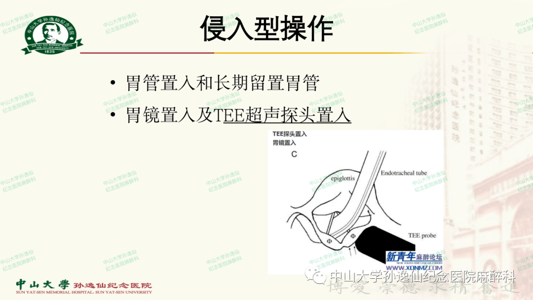 环杓关节脱位复位术图片