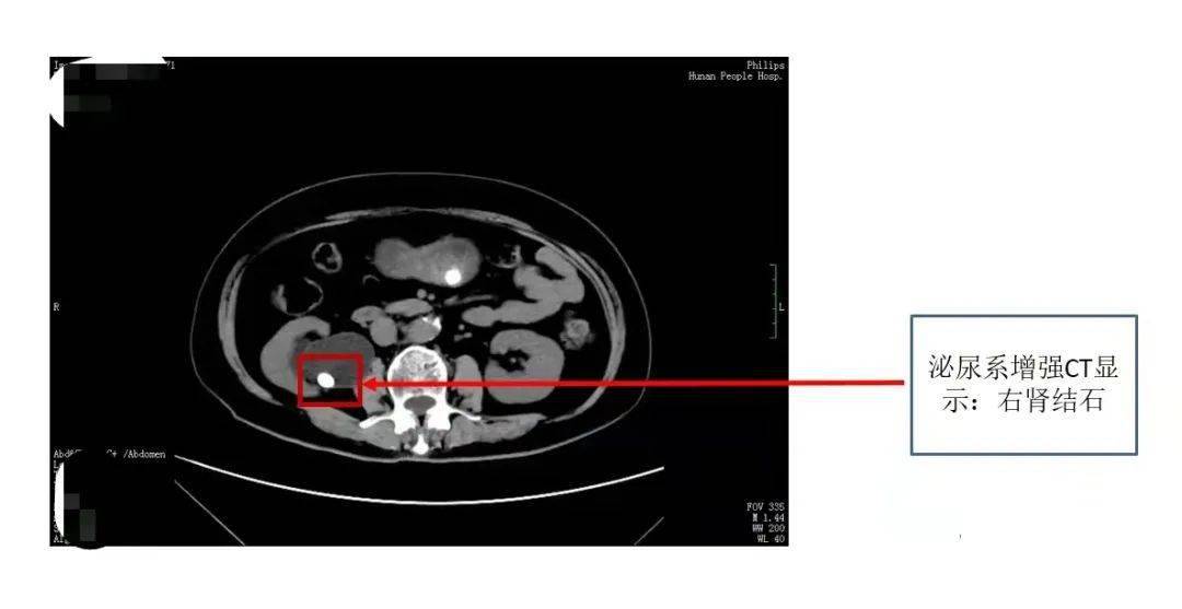 输尿管结石b超图图片