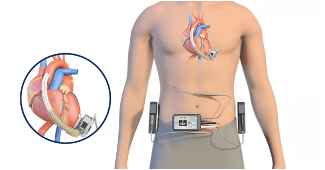 国内首款全磁悬浮式人工心脏获批上市，百洋投资布局高精尖医疗进入收获期