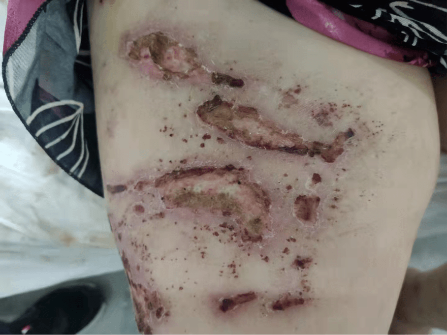 精心治疗与护理 溃烂皮肤终愈合