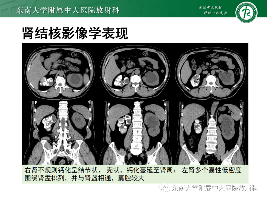 海绵肾影像图片