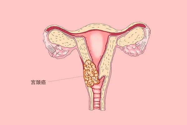 hpv陽性一定是宮頸癌?宮頸癌到來,身體有何提示?_女性_進行_疾病