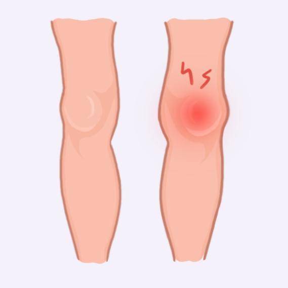 泡沫|膝盖疼、腿疼、脚疼……5种跑步损伤，专家教你处理！