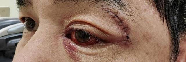 左眼流泪2年 一查竟是眼眶肿瘤_曾先生_手术_李东豪