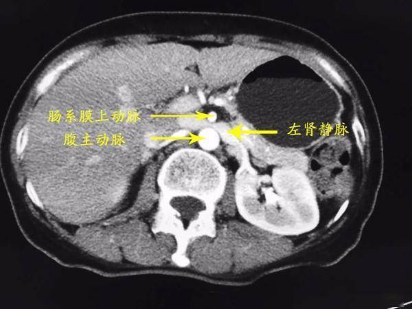 诊断|反复腰疼、血尿？泌尿外科提醒：请小心胡桃夹综合征！