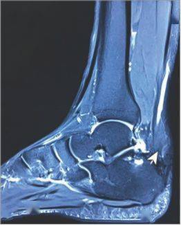 影像學檢查發現,腳踝關節mri提示右側跟腱處出現梭形增大:入院查體