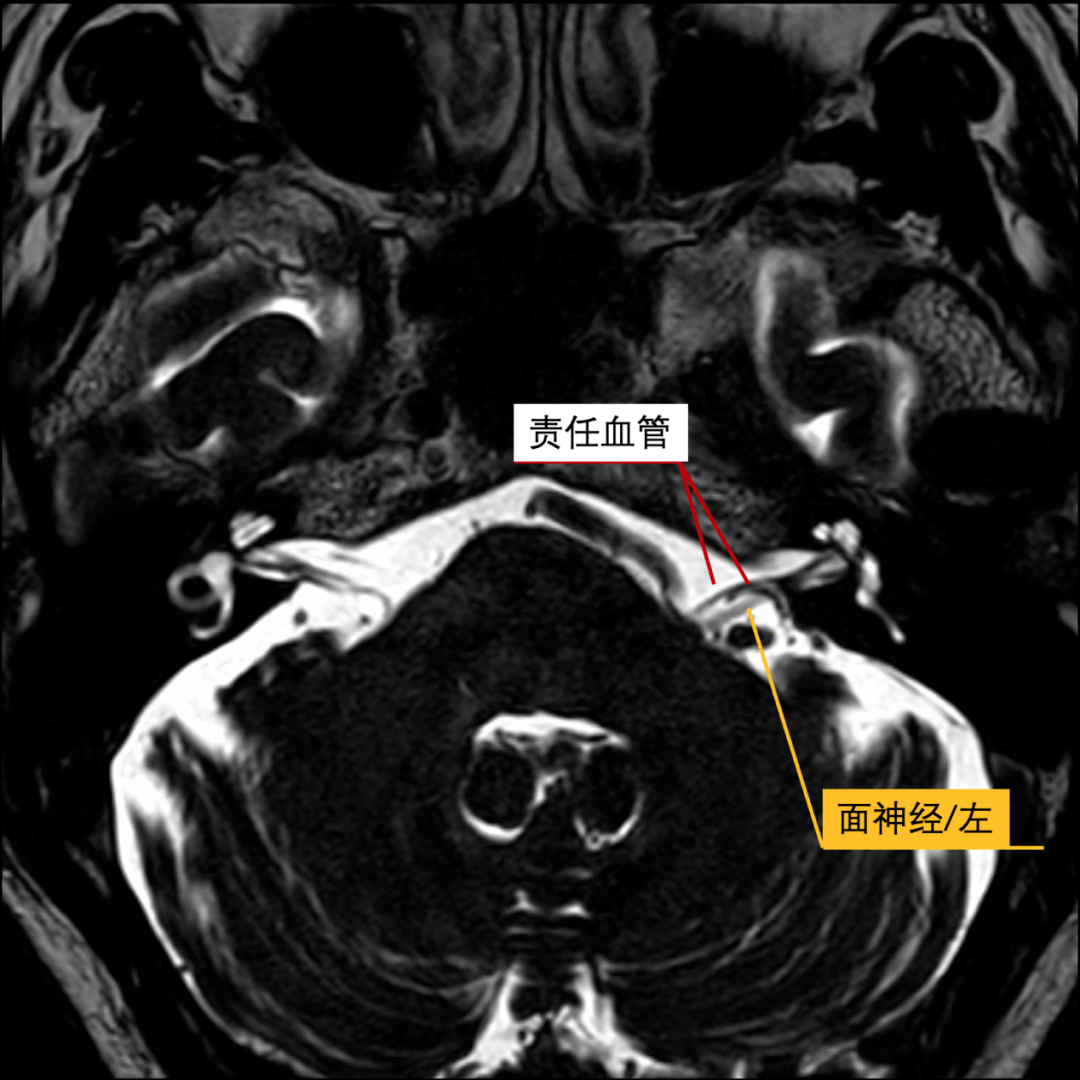 面神经管ct解剖图图片