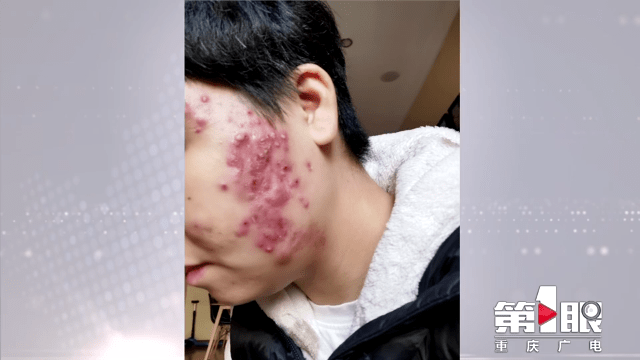 脸部做美容致面部大面积痤疮? 顾客商家各执一词