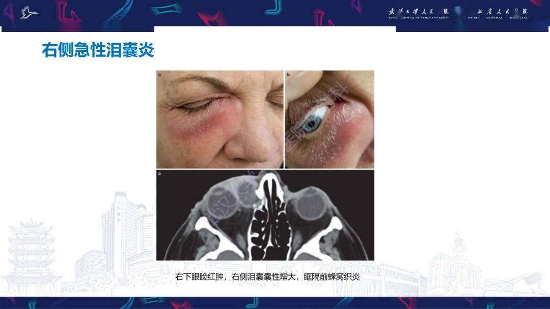 淚道病變影像診斷_全網_解剖圖_系統