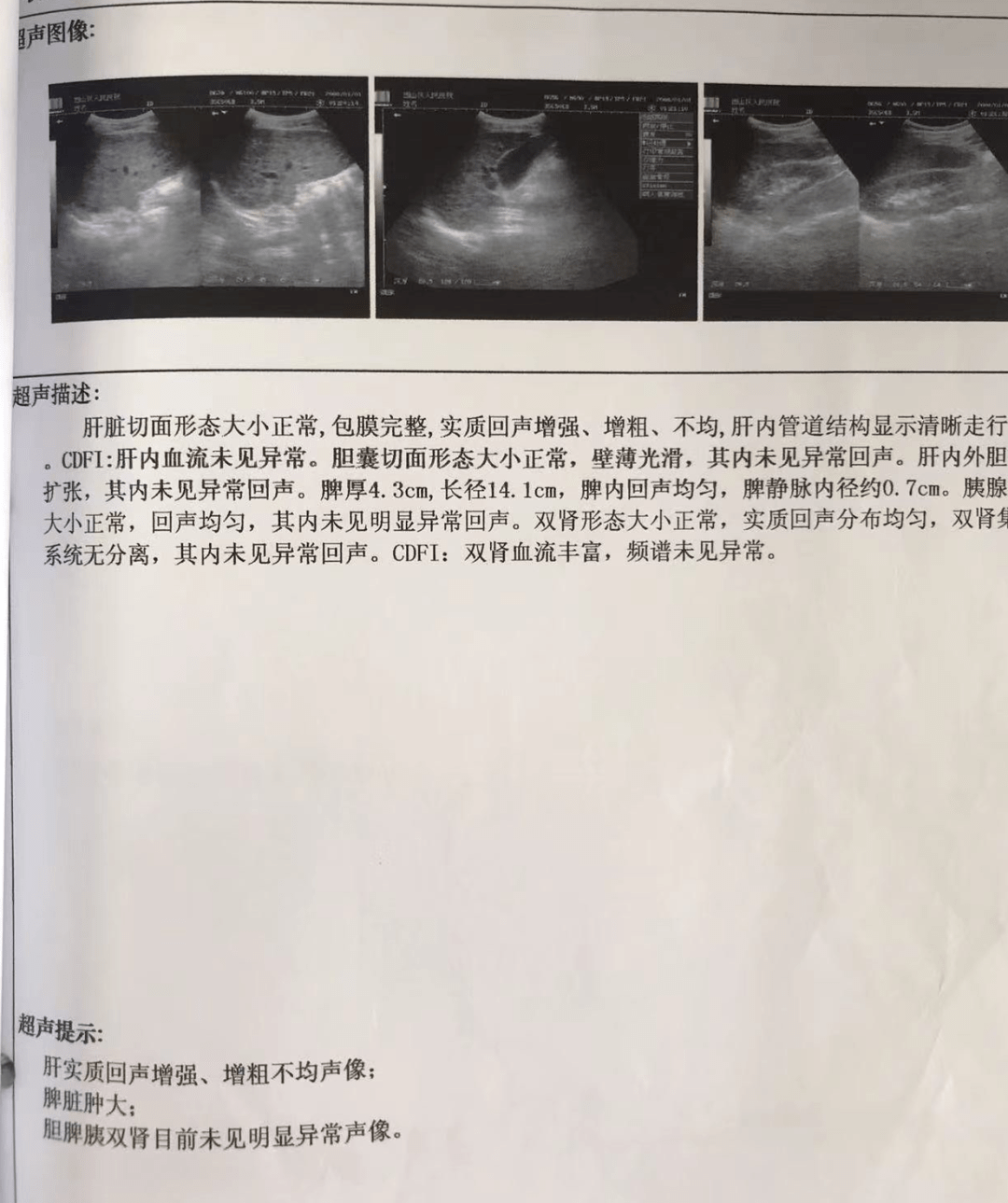 病例35歲男性雙手不自主抖動10年肝豆狀核變性繼發震顫