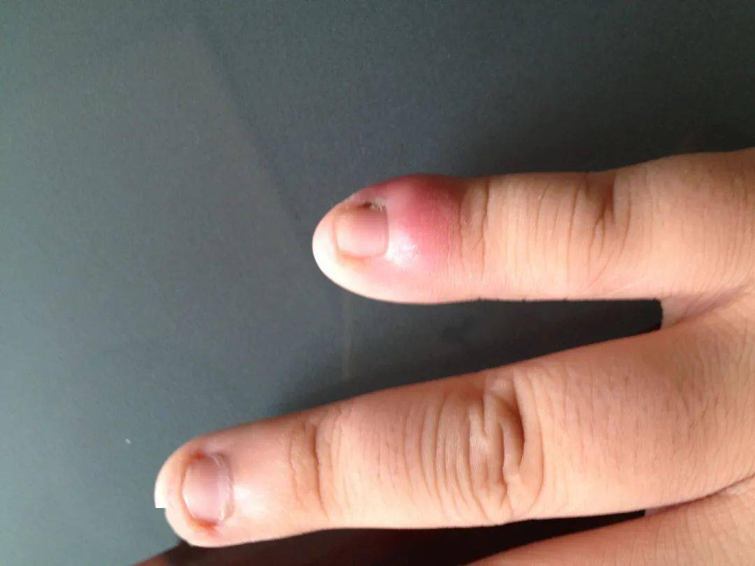 肺癌的早期手指图片