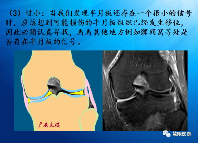 mri半月板損傷基礎