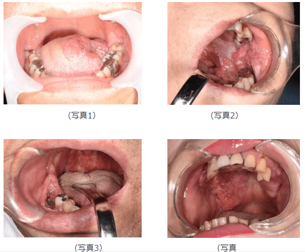 口腔癌的形成原因,典型症狀,診斷,先進治療方案_進行_療法_頭頸部