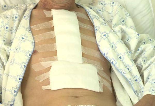 手术|男子胸痛两年没重视，差点被体内“定时炸弹”夺命