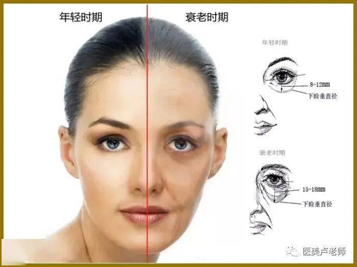 颜面老化的五个不同层次_面部_肌肉_整形