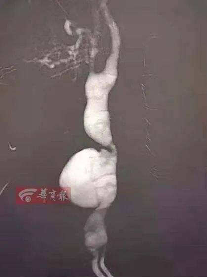 田先生|西安男子一个动作致颈部血管破裂…医生：立即手术！这个习惯你可能也有