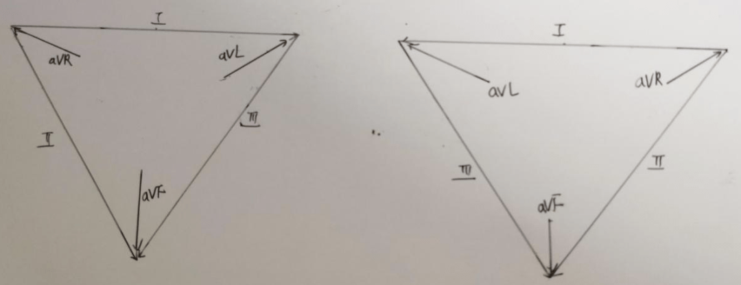 镜像右位心和左右手反接,心电图如何鉴别?_临床_肢体_互换