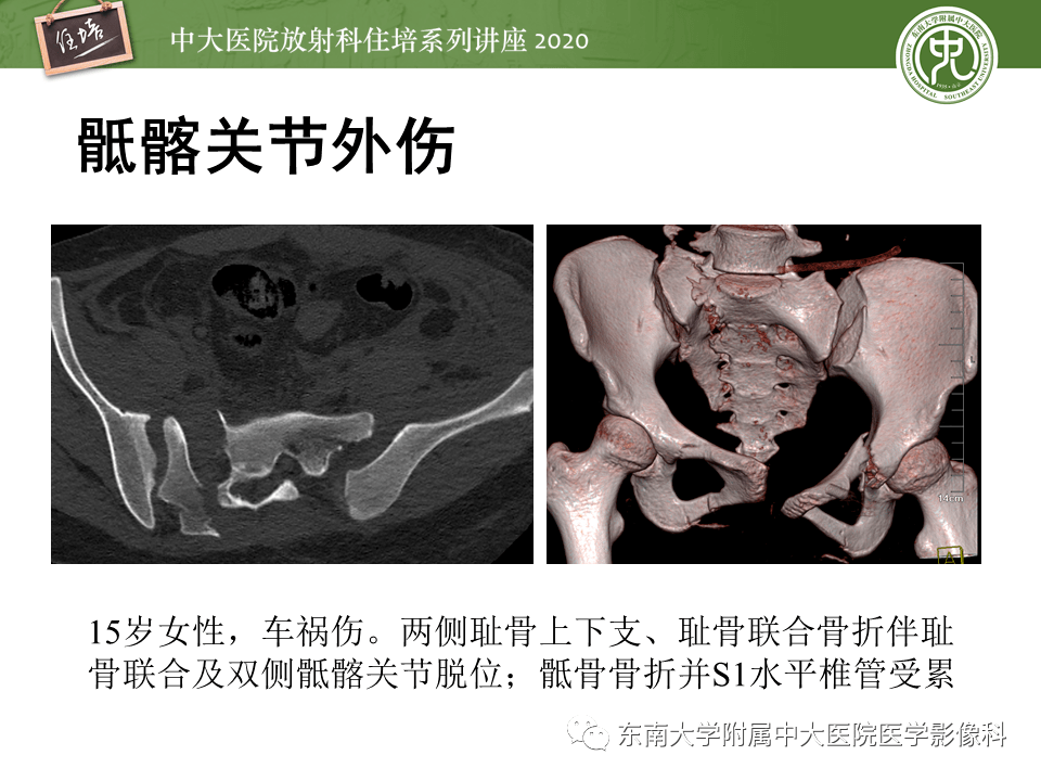 常见骶髂关节病变的影像表现