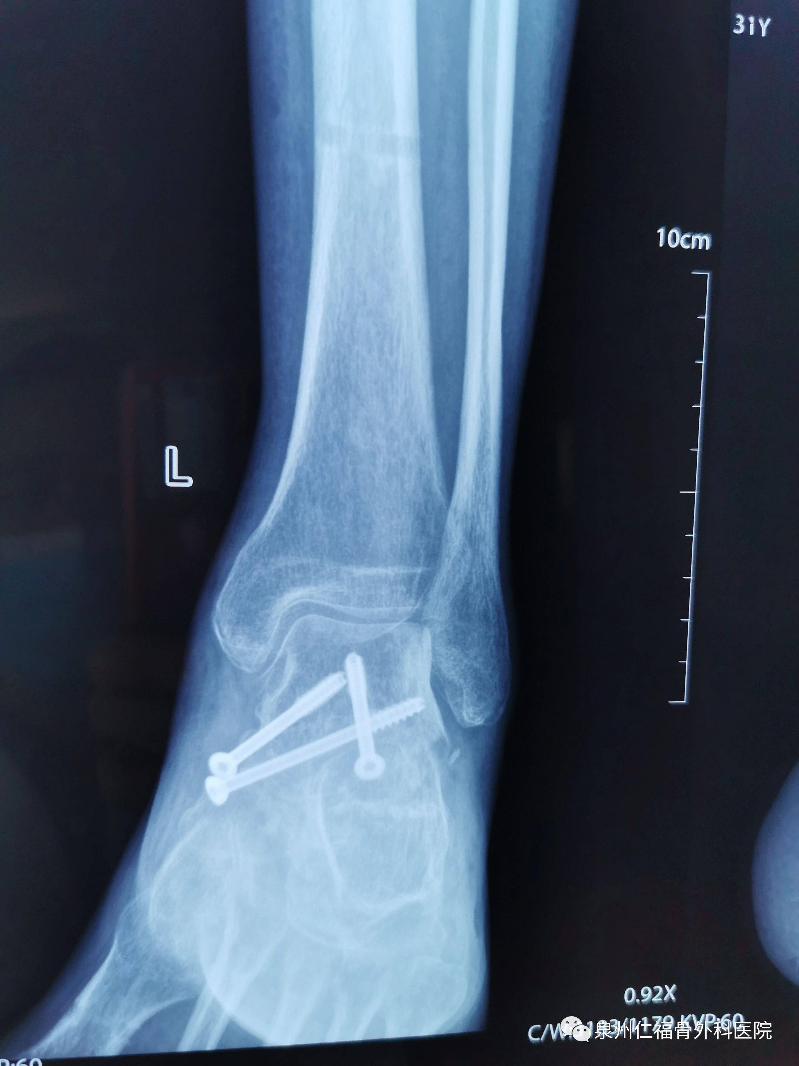 病例5:高处坠落致左距骨粉碎性骨折