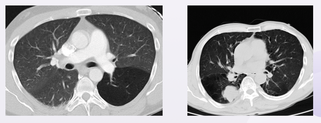 中央型肺癌ct影像图片图片