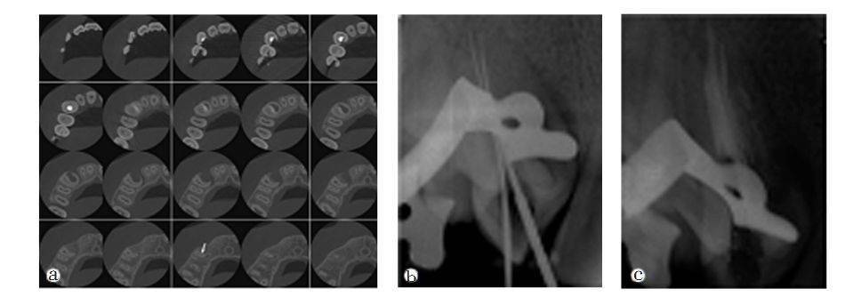 a ct掃描顯示上頜側切牙雙根管;b主尖銼x線片;c根充片如對mb2根管的