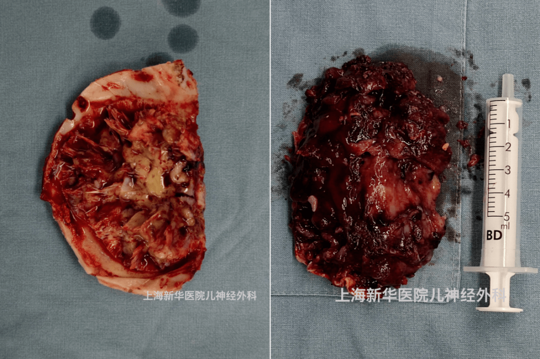 病例分享上海新华医院小儿神经外科儿童原发颅内尤文肉瘤1例
