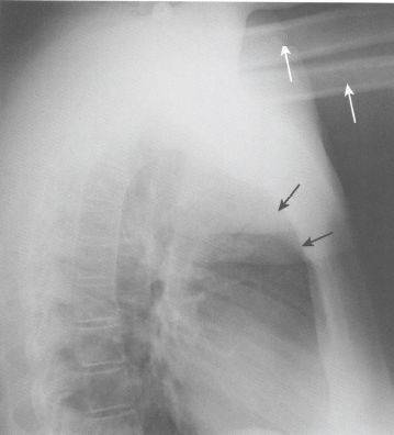 x线侧位胸片的诊断误区及解决方案_胸骨_间隙_水平