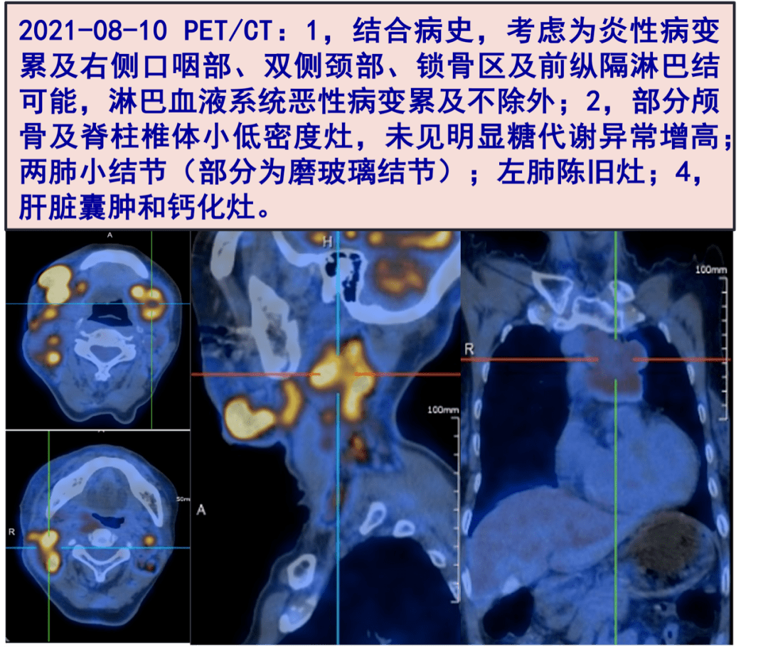 雙側頸部,鎖骨區及前縱隔淋巴結可能,淋巴血液系統惡性病變累及不除外