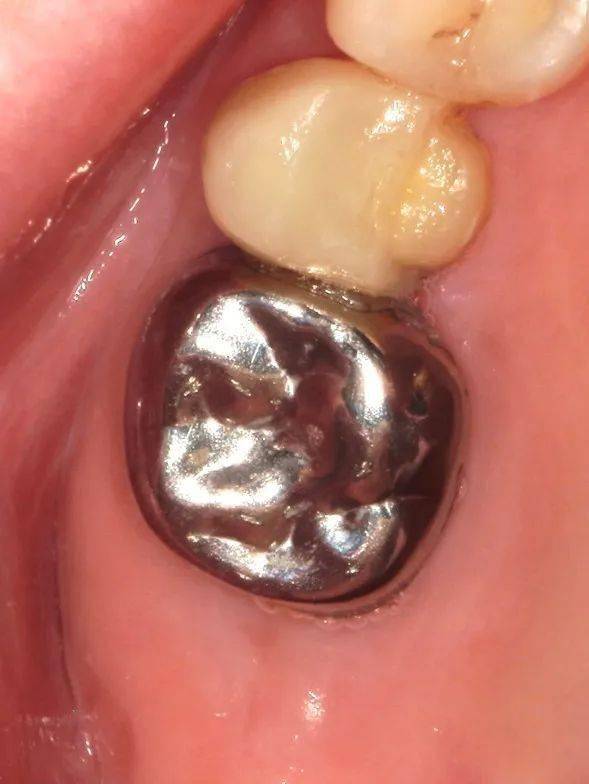 关于金属恒牙预成冠应用的思考—牙隐裂的金属预成冠临时修复