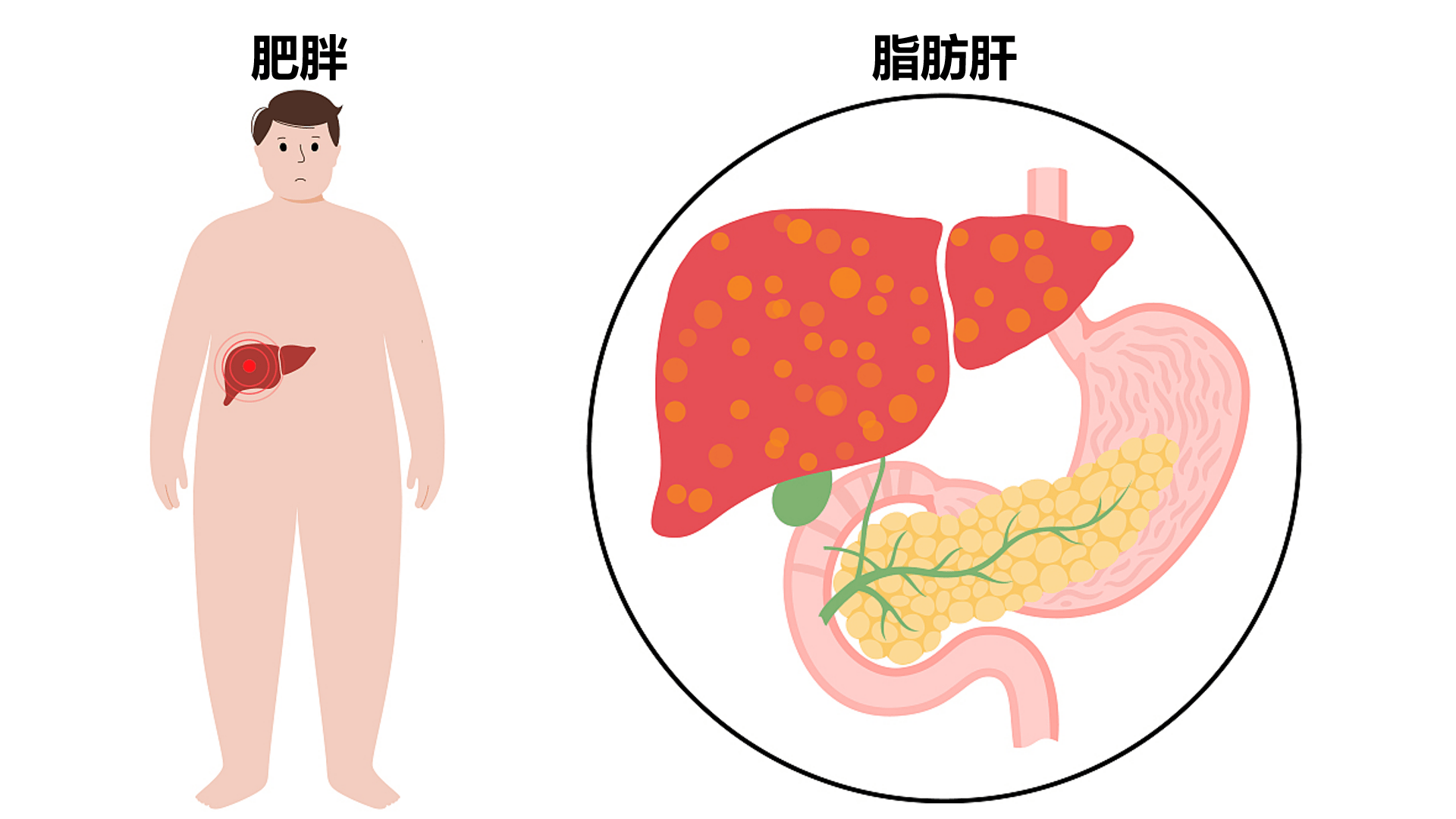 年纪与肥胖有关联,甚至间接与脂肪肝,高血脂,高血压等疾病有关今天