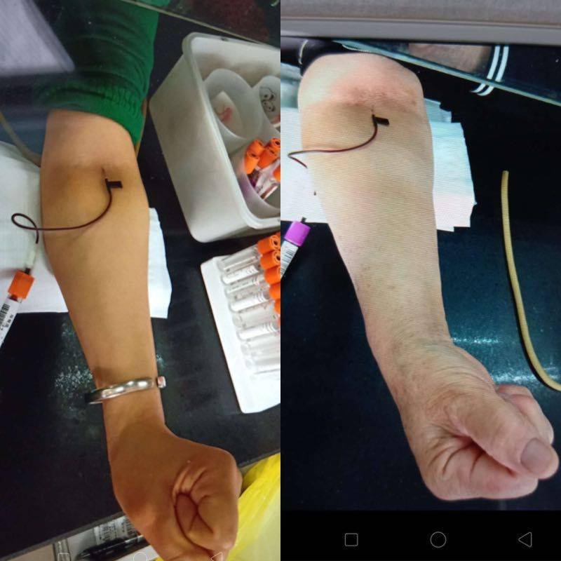 学会这四招再难找的血管你也能一针见血